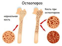 Протезирование зубов, удаление зубов и имплантация при остеопорозе: что нужно знать