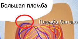 Болит зуб при накусывании, надавливании под пломбой