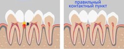 Ноющая зубная боль и воспаление десны. Болит зуб - опухла десна