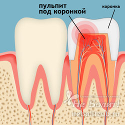 Болит живой зуб под коронкой при надавливании, "больно кусать"